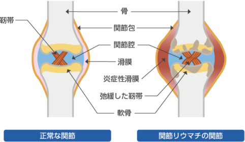 関節リウマチの関節